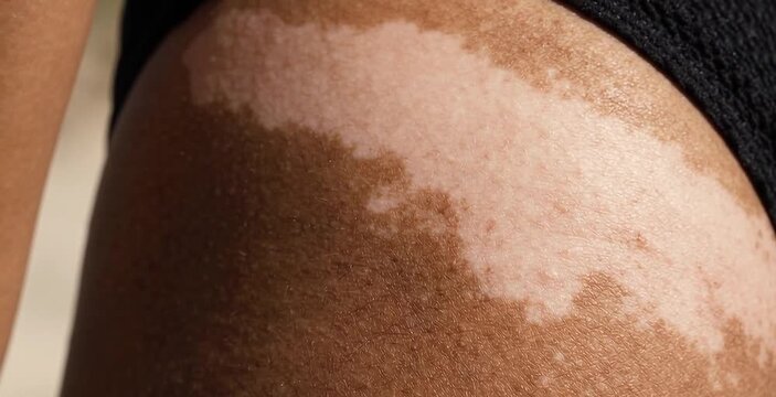 Macro Close Up of Large White Vitiligo Depigmentation Patch on Dark Tanned Skin