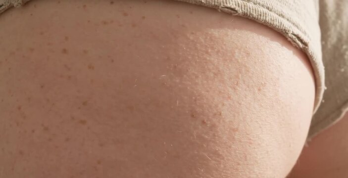 Close Up of Dense Natural Freckles and Hair Follicles on Woman Hip and Thigh