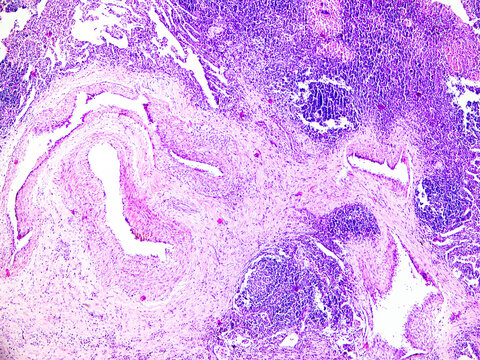 Tuberculosis is a chronic granulomatous inflammation characterized pathologically by tuberculous nodules, which consist of caseous necrosis, epithelioid cells, and macrophages.Magnify 40x.
