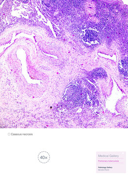 Tuberculosis is a chronic granulomatous inflammation characterized pathologically by tuberculous nodules, which consist of caseous necrosis, epithelioid cells, and macrophages.Magnify 40x.
