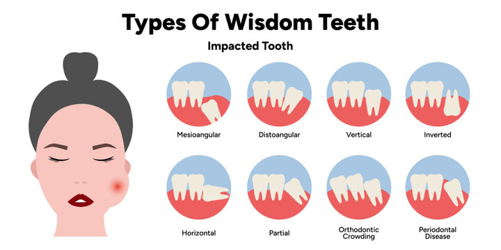 Hand-drawn dental medical illustration showing different types and anatomical positions of wisdom teeth, including common eruption patterns and impaction variations