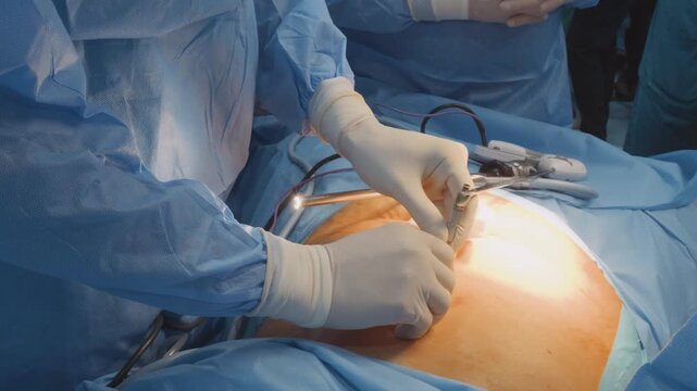 Surgeon Hands Inserting Laparoscopic Trocar and Endoscopic Light Scope Close Up