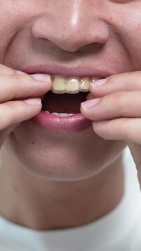 Extreme close-up of a person removing and inserting a clear dental aligner on lower teeth, orthodontic treatment and oral hygiene concept, vertical video