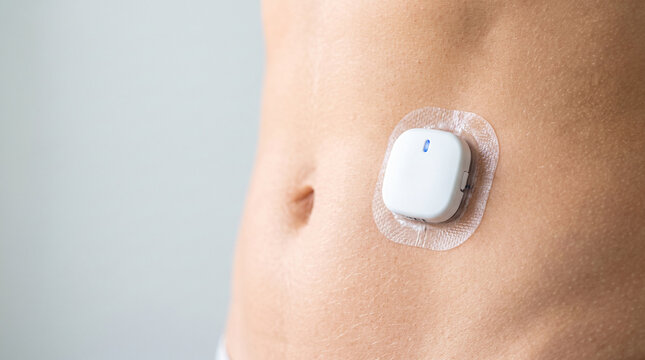 Sensor transmitter on abdomen for continuous glucose monitoring and real-time diabetes tracking.