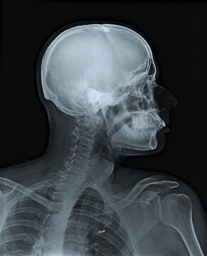 Lateral View Skull X-Ray Showing Cervical Spine and Cranium Profile