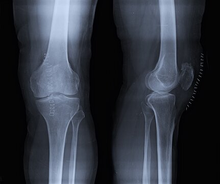 Knee Joint X-Ray Showing Patella, Femur, Tibia, and Fibula Views
