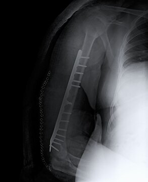 AP Shoulder X-Ray Showing Humeral Head Joint Prosthesis and Chest