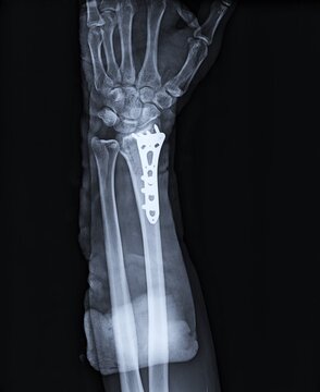 AP Forearm Radiograph Displaying Distal Radius Volar Plating with Immobilization Splint