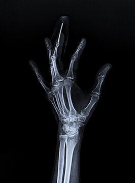 Oblique Hand Radiograph Displaying Middle Finger Kirschner Wire Pin Fixation