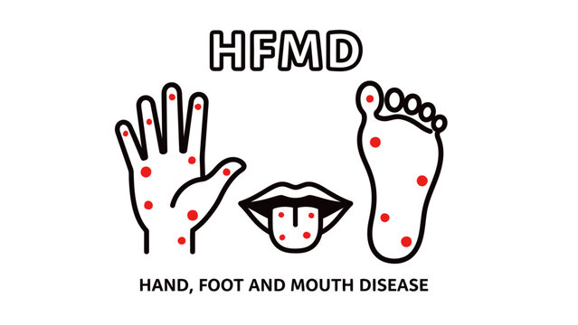 Medical vector illustration showing symptoms of Hand, Foot, and Mouth Disease (HFMD) with red spots on a hand, foot, and mouth, isolated on a white background.