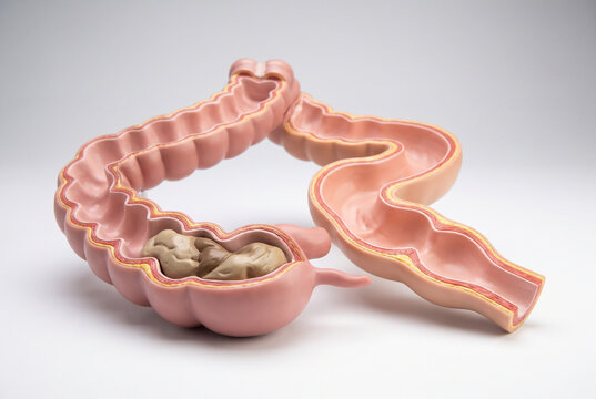 Large Intestine Anatomy Showing Bowel Obstruction, Medical Render