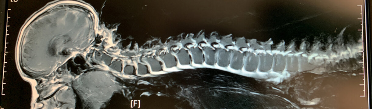 Spinal MRI Scan: A detailed sagittal view of a medical MRI showcasing the human spine and skull, revealing the intricate bone structure and surrounding tissues for diagnostic purposes.