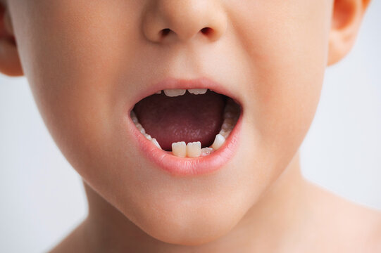 Close-up portrait of a young child with a missing baby tooth, illustrating natural tooth loss and the transition from primary to permanent teeth during childhood