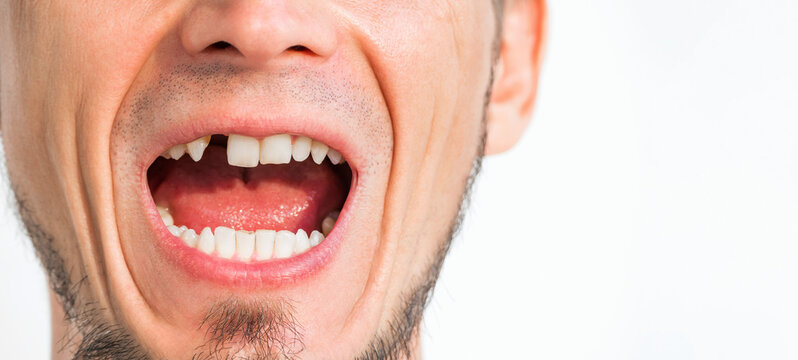 missing tooth close-up. Dental surgery and implantation. Portrait of an adult man with his upper front tooth removed on a white isolated background