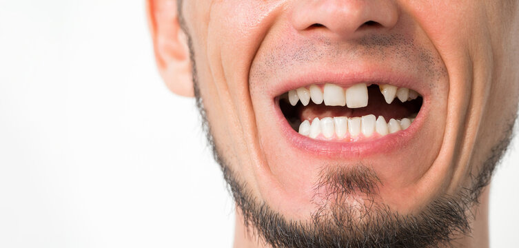 missing tooth close-up. Dental surgery and implantation. Portrait of an adult man with upper front tooth removed on a white isolated background