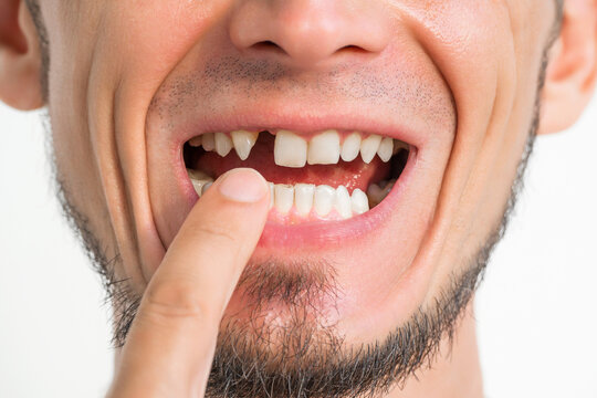 male missing upper front tooth removed. Dental surgery and dental implantation. Dental problems. Portrait of a adult man without a tooth on a white isolated background