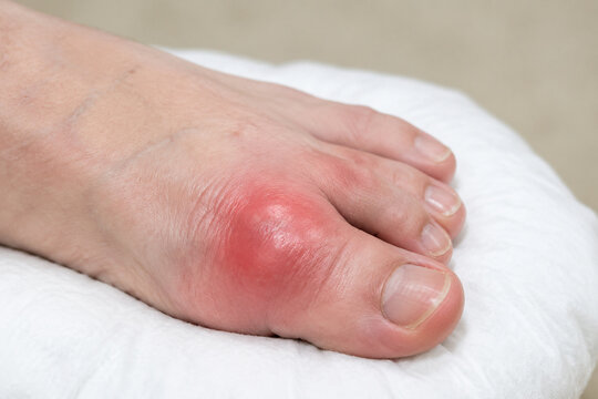 Swollen big toe joint on white cushion, gout and inflammation concept
