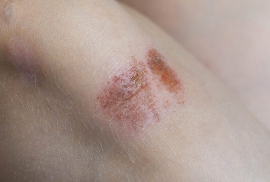 Close up view of scraped skin on human knee showing an abrasion wound, with visible red and raw areas, indicating fresh injury or beginning of healing process, detailed macro