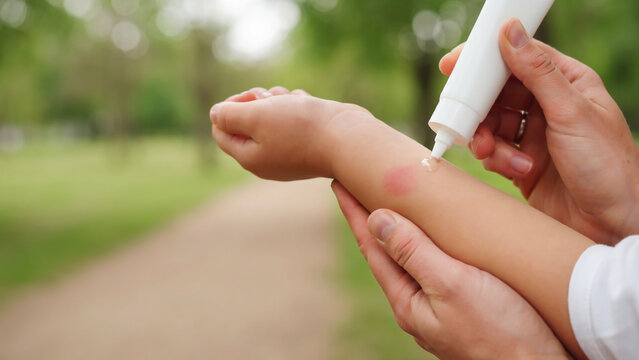 Mother applying pain relief cream to child arm in park