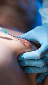 Gloved hand performs medical injection near nipple area of body; close-up view of syringe needle entering skin; gynecomastia, vertical photo