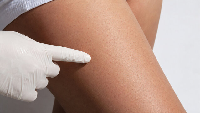 doctor in white glove pointing at skin with keratosis pilaris on womans leg. Dermatology examination of rash and irritated