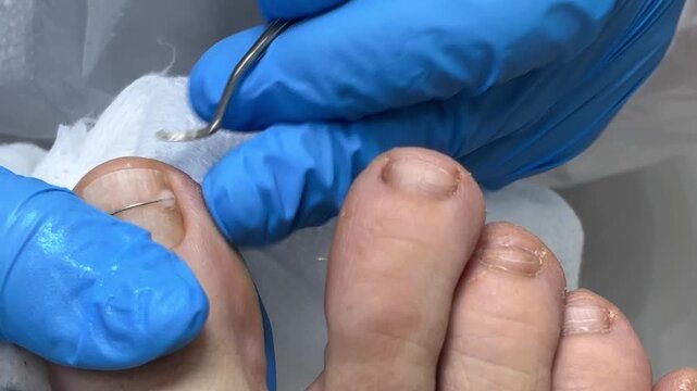 Podiatrist applying corrective brace wire on big toenail