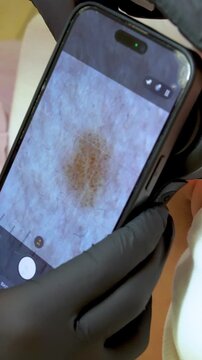 Skin cancer screening with digital dermoscopy, dermatologist examining a mole using a dermatoscope during a professional skin examination