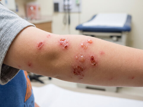 child's arm with blistering skin lesions from impetigo or viral rash in clinical setting.