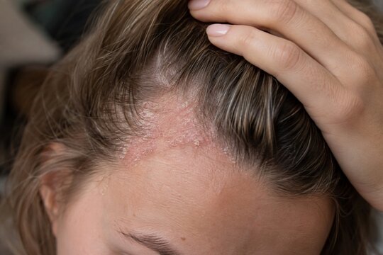 Scalp irritation and flaky skin near hairline