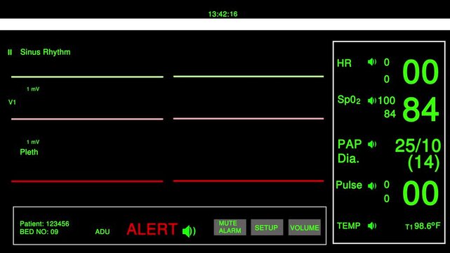 Digital hospital patient monitor screen showing vital signs and heart rate data in an intensive care unit room for medical emergency monitoring and healthcare analysis of patient health status