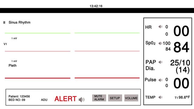 Medical patient monitor screen showing vital signs and flatline heart rate with active alert warning in a hospital room setting for critical care monitoring and emergency healthcare patient status