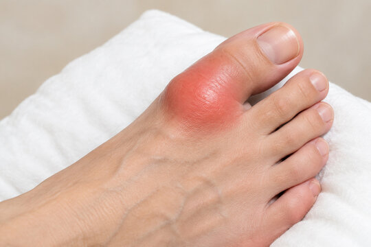 Swollen big toe joint on white cushion, gout and inflammation concept