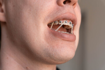 Close up of teeth with metal braces and orthodontic elastics inside an open mouth. Elastic bands help correct bite alignment during orthodontic treatment © Renata