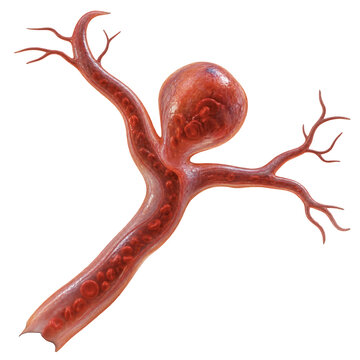Cerebral arterial branch with saccular aneurysm at the bifurcation filled with red blood cells. Brain vessel pathology and stroke risk. Medical 3D anatomy illustration on transparent background.