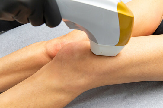 Female leg undergoing laser hair removal treatment with a handheld device in a clinical setting, close-up view of knee area and skin texture