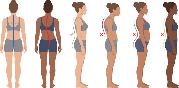 Spine alignment and posture types diagram, scoliosis kyphosis lordosis, vector illustration