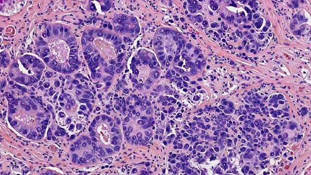 Microscopic pathology view of a carcinoma exhibiting abnormal glandular structures and malignant epithelial cells featuring enlarged nuclei and prominent nucleoli surrounded by fibrous tumor stroma