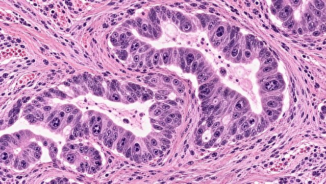Histological slide of adenocarcinoma showing glandular formation and sheets of atypical epithelial-like cells with large hyperchromatic nuclei and prominent nucleoli in a dense tumor stroma