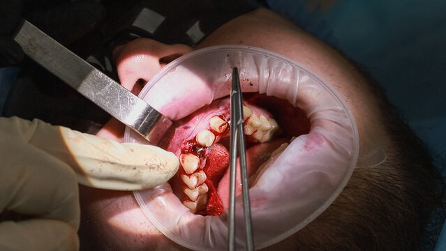 Close-up oral treatment showing dental instruments and a drill being used on the patient&rsquo;s teeth, while water is sprayed to rinse the treatment area and a saliva ejector removes fluids, face excluded 