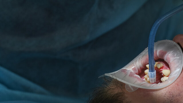 Dental procedure in close-up, dentist working on patient teeth with specialized instruments while assistant uses saliva ejector, detailed view of mouth without visible face banner copy space