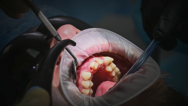 Close-up oral treatment showing dentist using dental drill and instruments on patient teeth, with saliva ejector positioned inside mouth, face excluded from frame