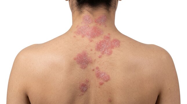 Back View of Patient with Severe Nummular Eczema Psoriasis or Lupus Red Plaques