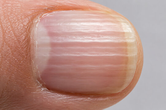 Horizontal Nail Ridges Close Up Showing Beau's Lines and Fingernail Surface Changes for Dermatology, Nail Health and Medical Diagnosis