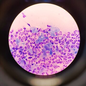 Microscopic view of Trichomonas vaginalis protozoa surrounded by numerous white blood cells (leukocytes) in a stained urogenital smear sample.