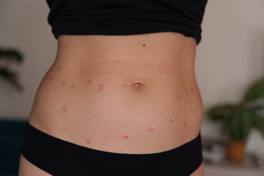 Harvest mite bites causing red itchy rash on woman abdomen