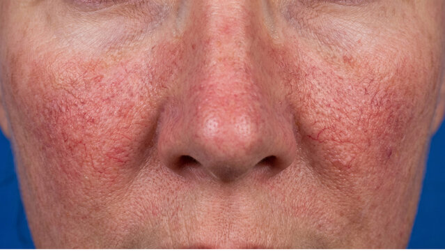 Malar rash on a patient's face presents as a symmetrical red butterfly pattern across the nose and cheeks.