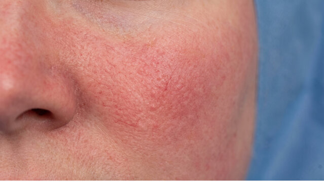 Rosacea on a woman's cheek displays characteristic facial redness, broken capillaries, and mild inflammation.