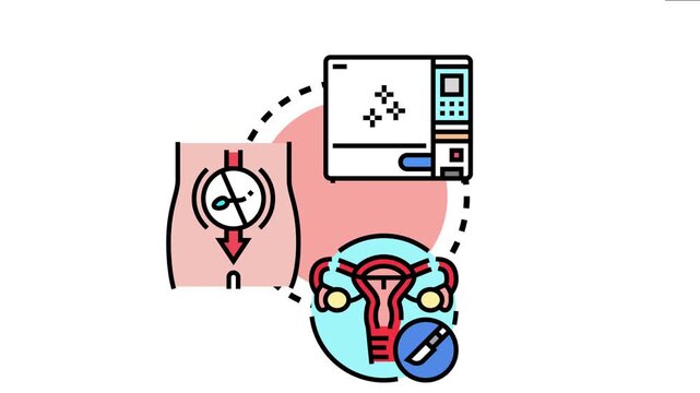 Medical sterilization concept showing sterilization machine, preventing fertilized egg implantation, and female reproductive system surgical tubal ligation procedure