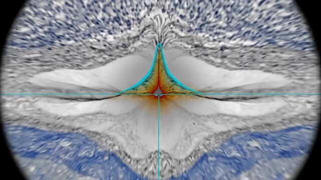 Foveal Vitreous Traction in Ophthalmic OCT Cross Section for Retinal Education
