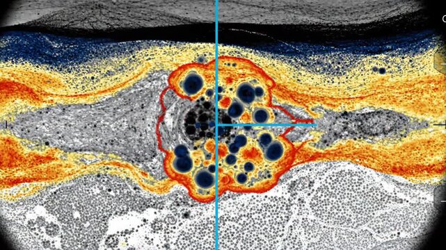 Retinal OCT Scan Showing Diabetic Macular Edema with Intraretinal Cysts for Ophthalmology Education